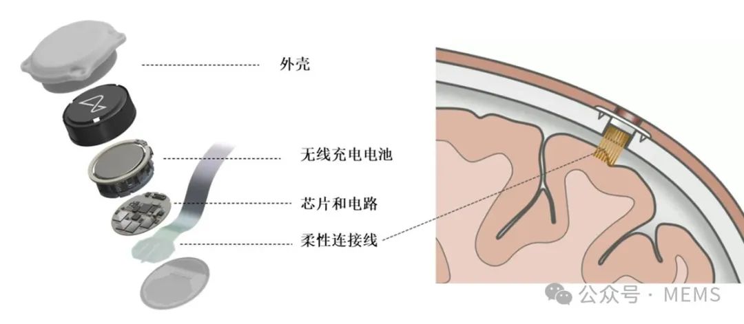 基于MEMS超声波的无线植入式脑机接口技术前瞻